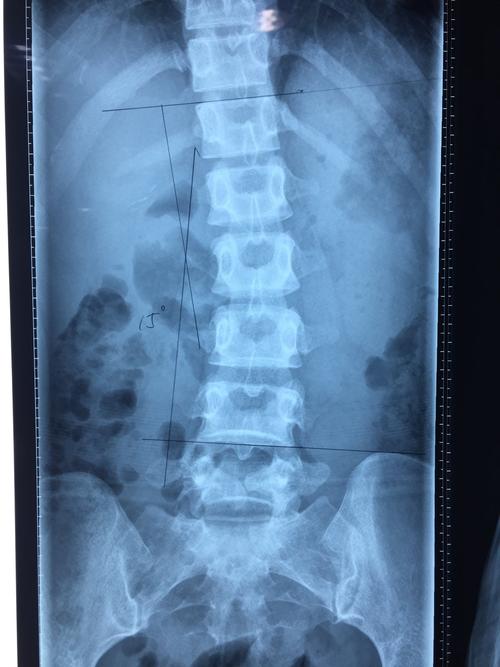 腰椎侧弯畸形怎么办?