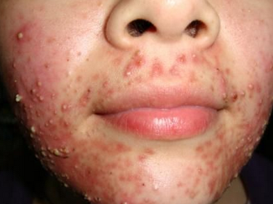 临床痤疮什么症状