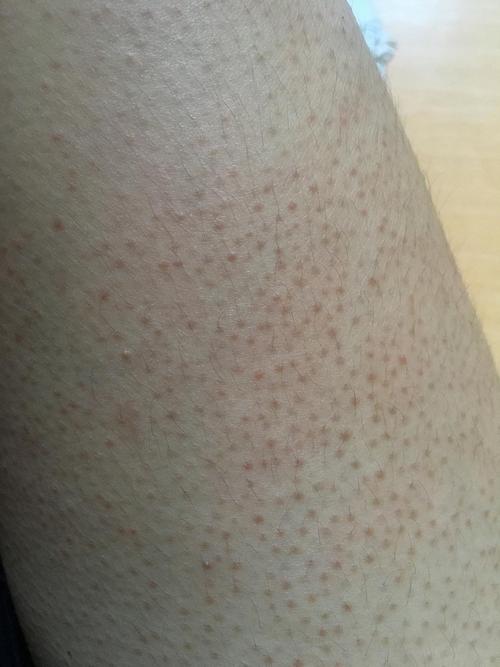 有人比我鸡皮肤更严重的吗!求支招啊集美们!