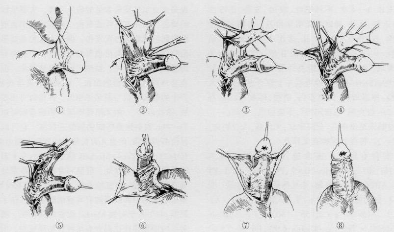 尿道下裂成形术