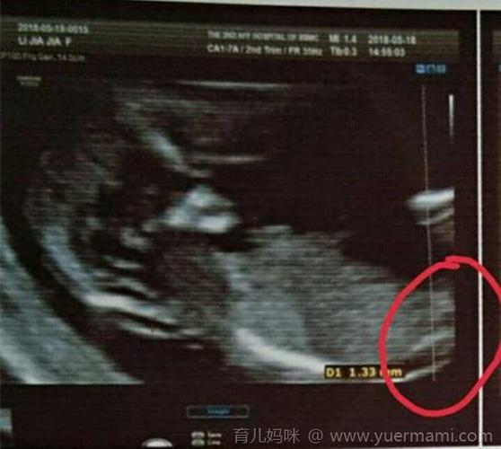 nt图有三条线在哪里都说三条线的85是女宝