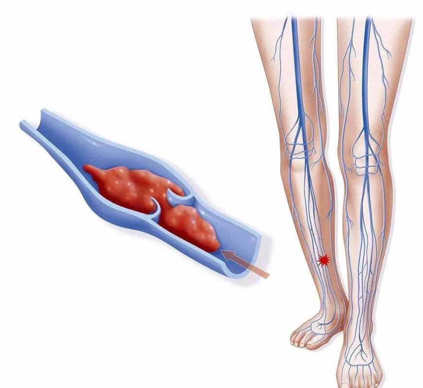 骨科病人下肢静脉血栓知识点