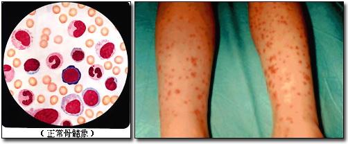 【临床助理医师内科学备考:淤滞性紫癜早期症状】