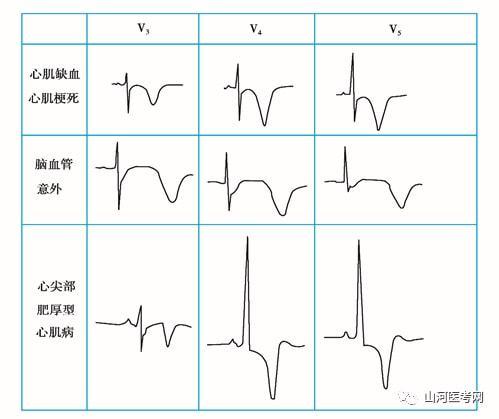 辅助检查心电图心肌缺血与stt改变