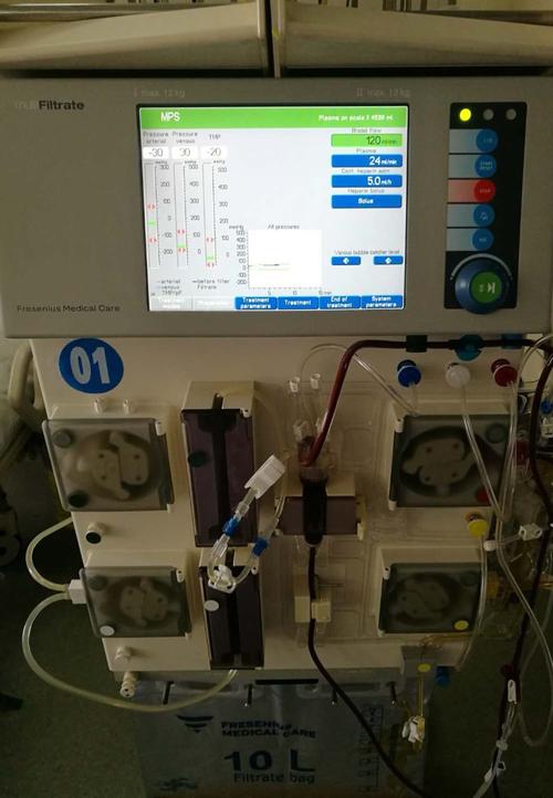 血浆置换进行中密切观察费森尤斯机器各数值在正常范围内,为患者进行