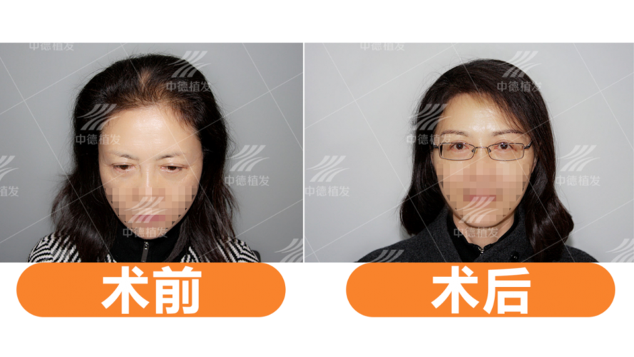 在眉毛缺失等先天不足的情况下,就需要后天打造了,那么通过什么方法呢