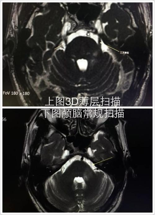 三叉神经痛?核磁共振放大招揪出元凶!——市人民医院
