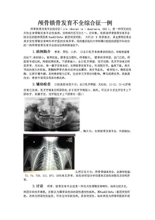 颅骨锁骨发育不全综合征一例颅骨锁骨发育不全综合征cleirania.doc