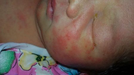 新生儿中毒性红斑的介绍