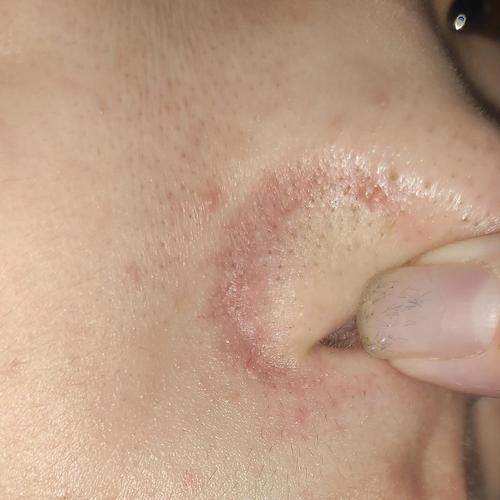 鼻翼泛红脂溢性皮炎记录贴有皮肤高清图片慎入