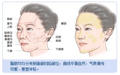 自体脂肪填充面部 改善干瘪凹陷 给你鲜活美颜