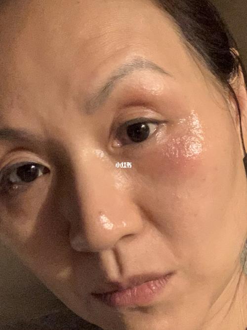 眼周过敏_过敏_补水_皮肤过敏_面霜_喷雾_眼药膏_精华