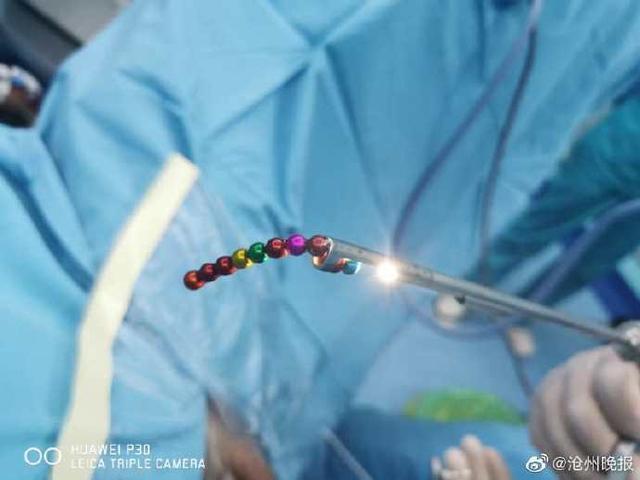 廊坊一男子将54颗磁力珠塞入尿道,医生手术为他取出