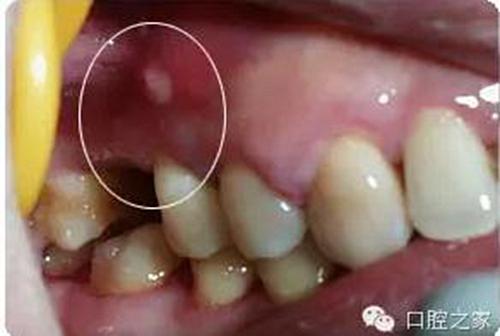 经久不愈的瘘管,久治不愈的根管 科贸嘉友收录 ②产生根尖周慢性炎症
