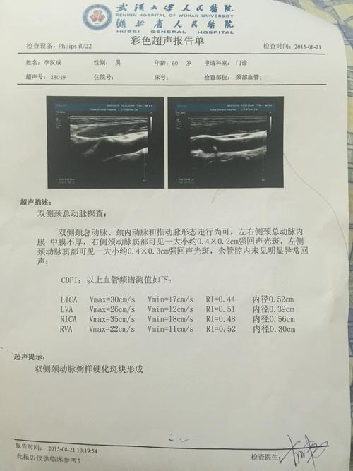 请医生帮忙看cta结果,第三条"突起"是可能有颈动脉瘤吗?