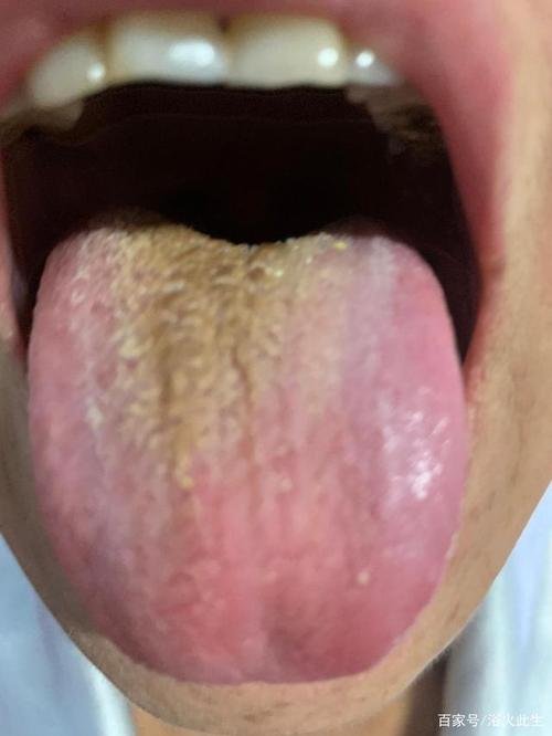 这个图片,是一位胃癌患者的舌苔!