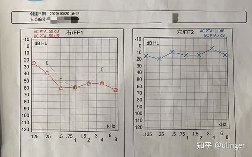 吃了药,20号入院第一天的听力报告(下降ac60左右),低频恢复很多