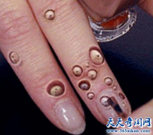 空手指莲蓬乳空手指是怎么形成的空手指图片