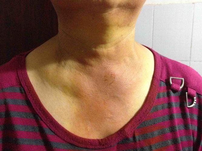 起源地在颈部胸锁关节上