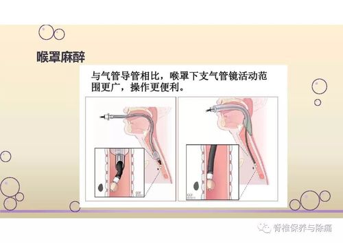 无痛呼吸内镜介入治疗病人的处理要点