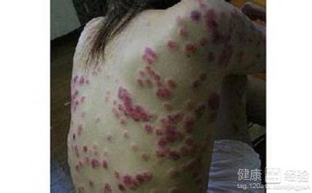 红斑狼疮的晚期症状