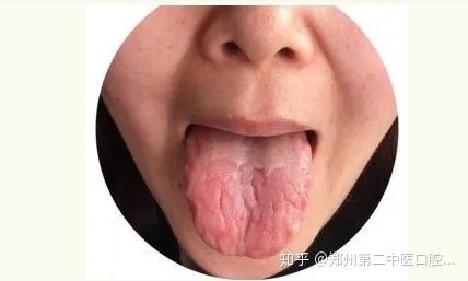 裂纹舌是什么原因裂纹舌很严重怎么办