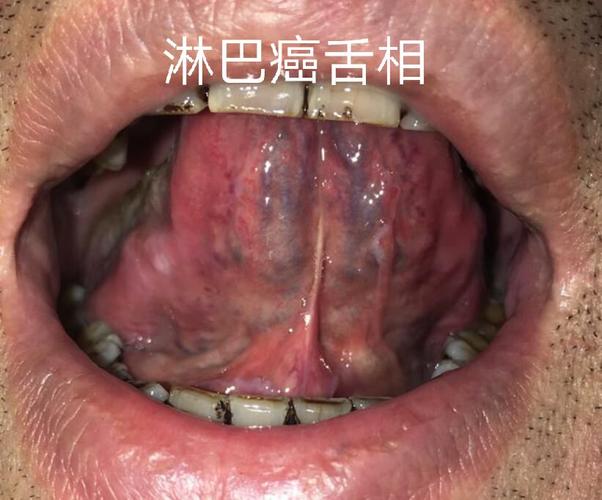 所以中医治未病可预防癌