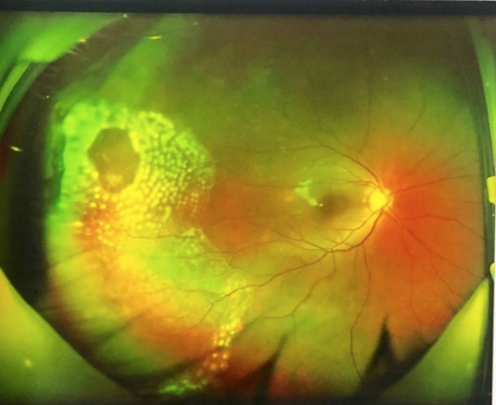 阳阳术后的眼底照相图