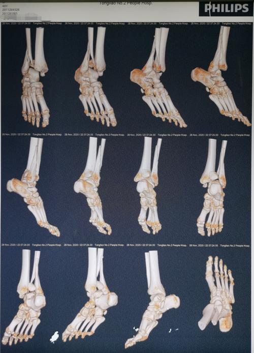 术前ct三维重建