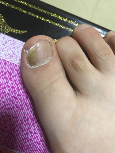 这个是不是灰指甲 现在严不严重?