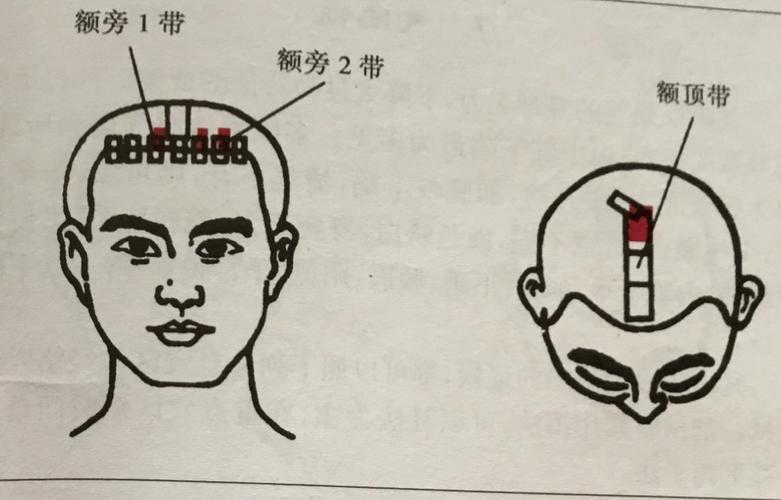 头部额旁1带(双侧),额旁2带(左侧),额顶带中1/3.