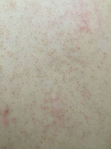 密集恐惧症慎入 后背皮肤毛孔粗大恶心到我自己了,怎么办怎么办?