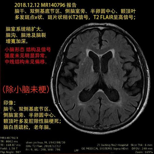 脑白质疏松,老年脑.