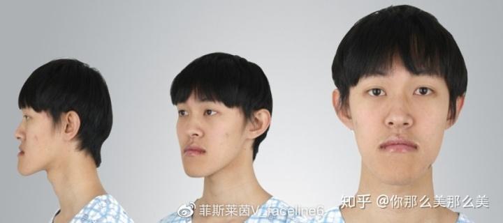 鞋拔子脸怎么矫正?