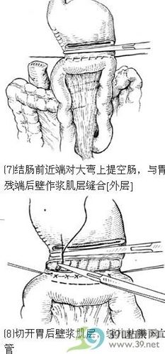 胃空肠吻合术的手术步骤