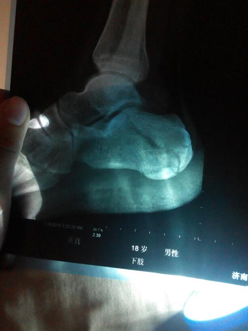 跟骨粉碎性骨折 一个月了 第一张是一个月之前拍的 后面是今天刚拍的