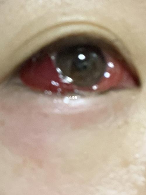 斜视手术后有个血泡 图2慎点_美妆_医美_整容_美妆_医