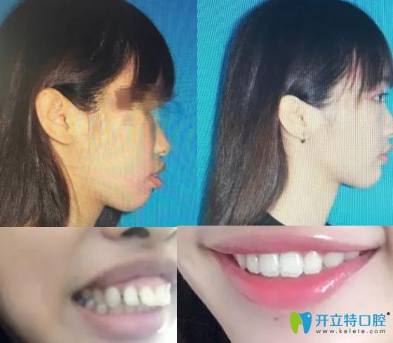 盛德仁龅牙矫正案例前后对比图:矫正牙齿移动的范围都是前后方向