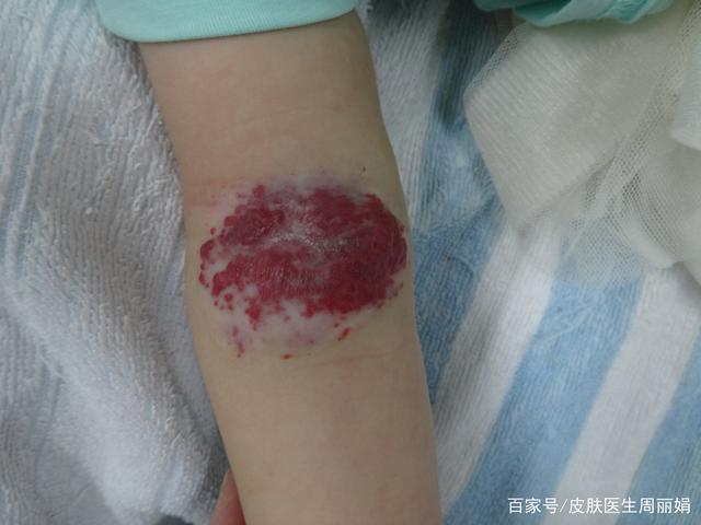 血管瘤的早期症状有哪些?怎么早期发现血管瘤?