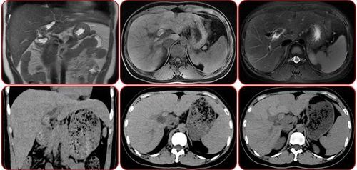上腹部ct及磁共振检查