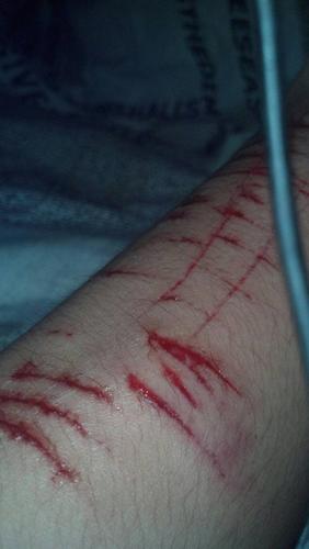 失恋了,为了掩盖内心的伤痛,用剪刀把手划成这样,不知道会不会留疤