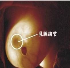 乳腺三级结节买不了医疗险吗 有乳腺结节三类能上保险