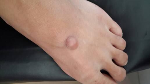 请问我脚上长的这个是什么?