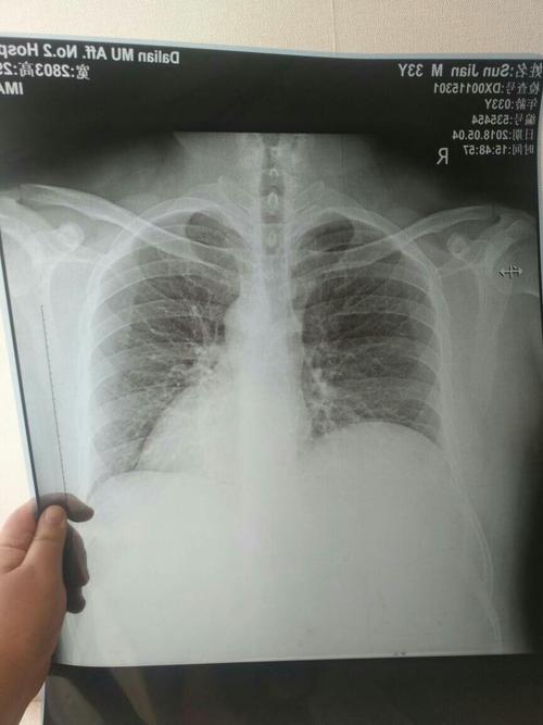 有没有懂的看ct胸片的,肺部咋样,谢谢了