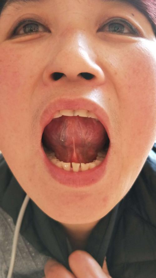 舌下有一条明显青筋!说明脑部微循环开始淤堵!