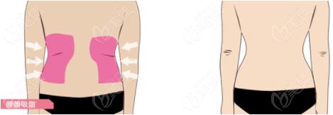 华美抽脂效果怎么样呢从厦门华美5s紧肤腰腹吸脂优势来看确实好