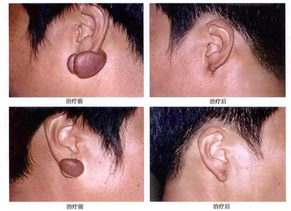 穿耳洞后瘢痕增生治疗效果