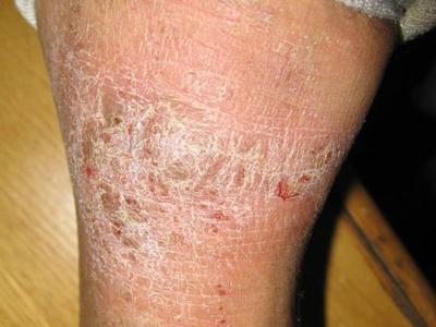 湿疹是一种容易复发的皮肤病,治疗需要专用药康,也是一种过敏性炎症性