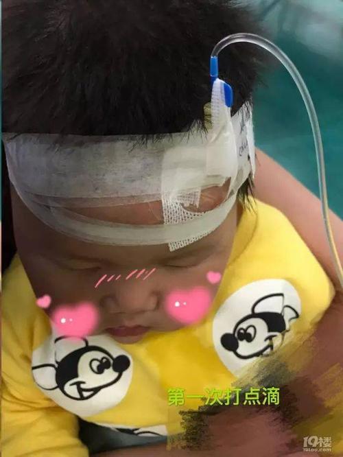 宝宝第一次头上打针挂水 挂了两天的抗生素和雾化,复查又验了个血