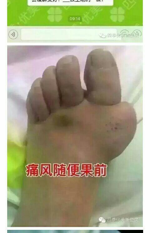 肿胀变形的脚,伙伴说痛起来生不如死!